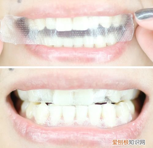 牙贴副作用是什么？ 牙贴对牙齿有伤害吗