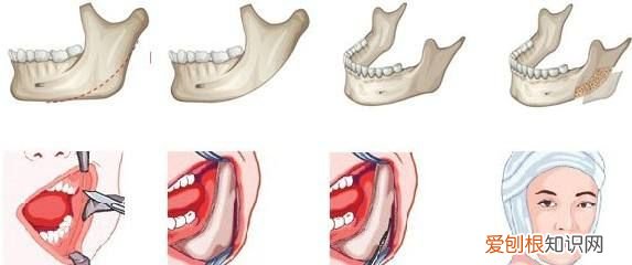 神秘的“磨骨”手术 削骨手术过程是怎样的