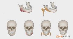 神秘的“磨骨”手术 削骨手术过程是怎样的