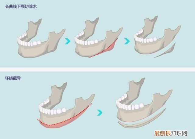 神秘的“磨骨”手术 削骨手术过程是怎样的