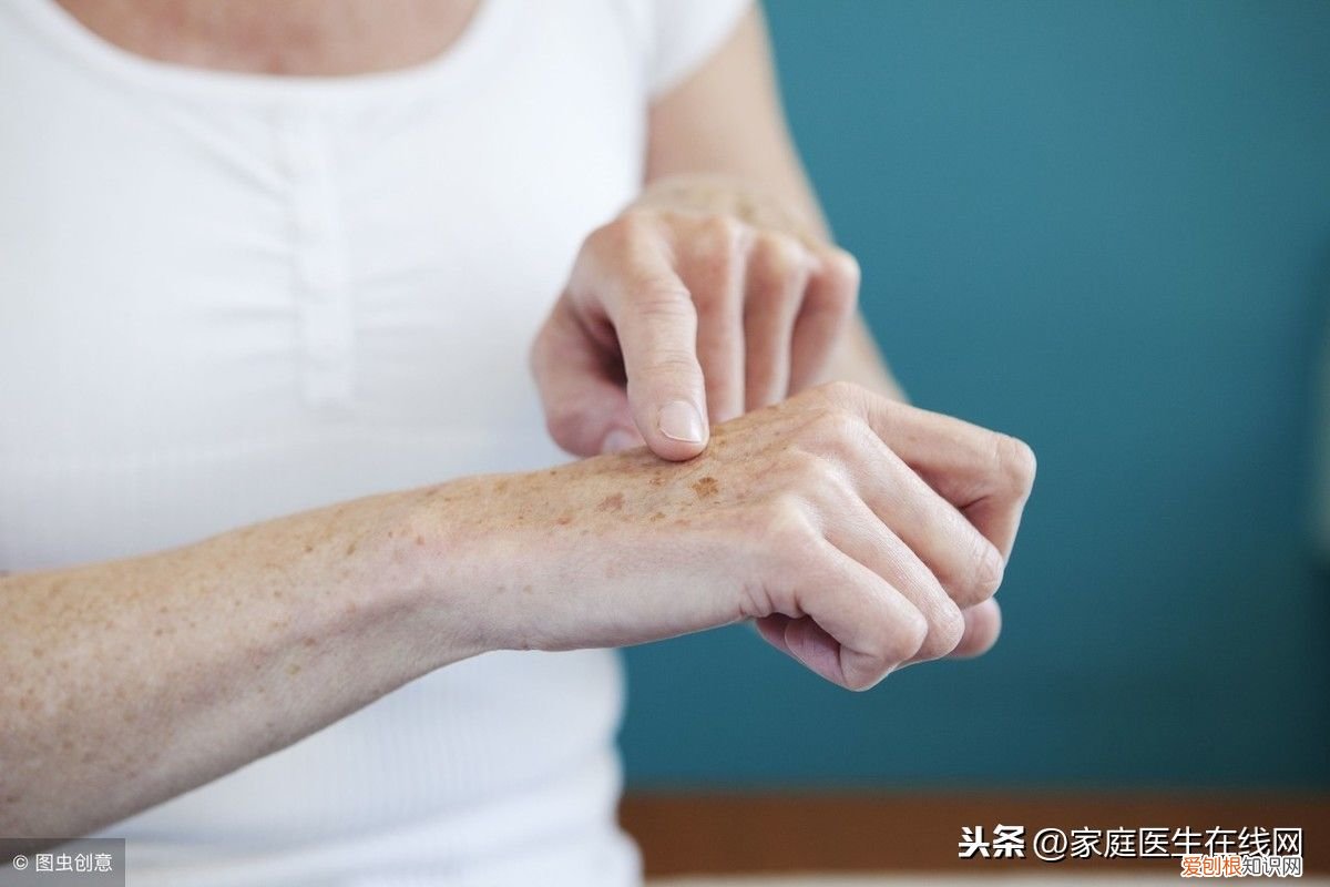 长老年斑该怎么办 老年斑怎么去除窍门