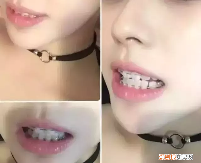 牙齿矫正对颜值有多大影响 牙齿矫正图