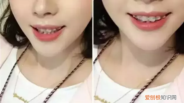 牙齿矫正对颜值有多大影响 牙齿矫正图