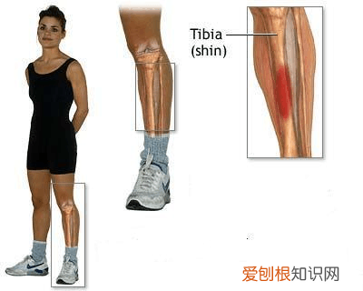 小腿骨膜炎的主要症状有哪些？ 小腿骨膜炎的症状