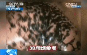 看看内窥镜下吸烟者的肺 吸烟者的肺