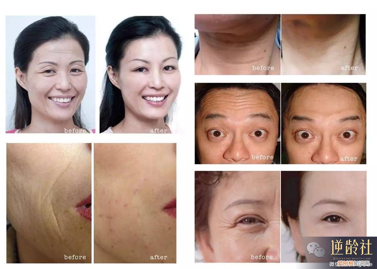 注射祛皱之肉毒祛皱 生物注射除皱