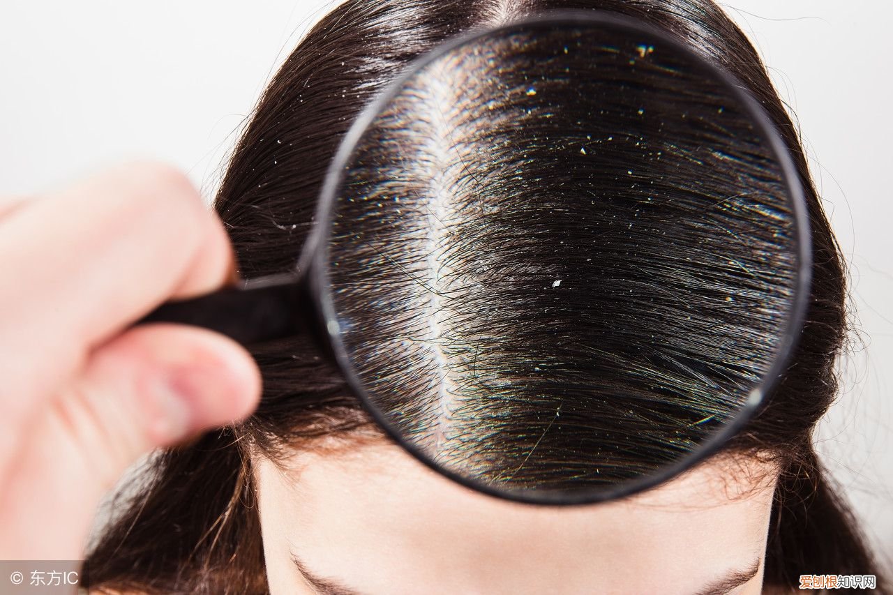 头皮屑过多怎么办？ 怎样去屑