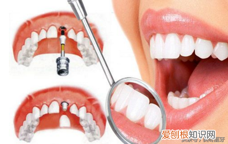 牙掉了能否马上种植牙 牙齿掉了能种植牙吗