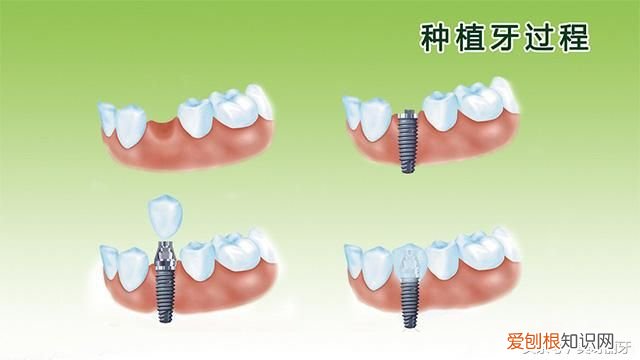 牙掉了能否马上种植牙 牙齿掉了能种植牙吗