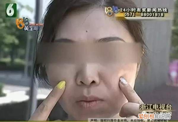 女子嫌自己法令纹太深 法令纹不对称