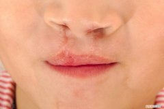 治疗唇炎，有效的措施有哪些 唇炎怎么办