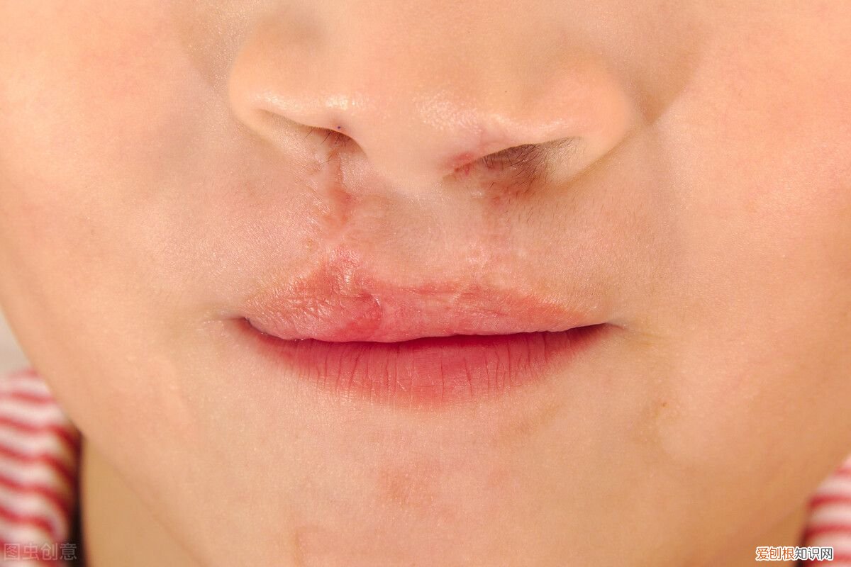 治疗唇炎,有效的措施有哪些 唇炎怎么办