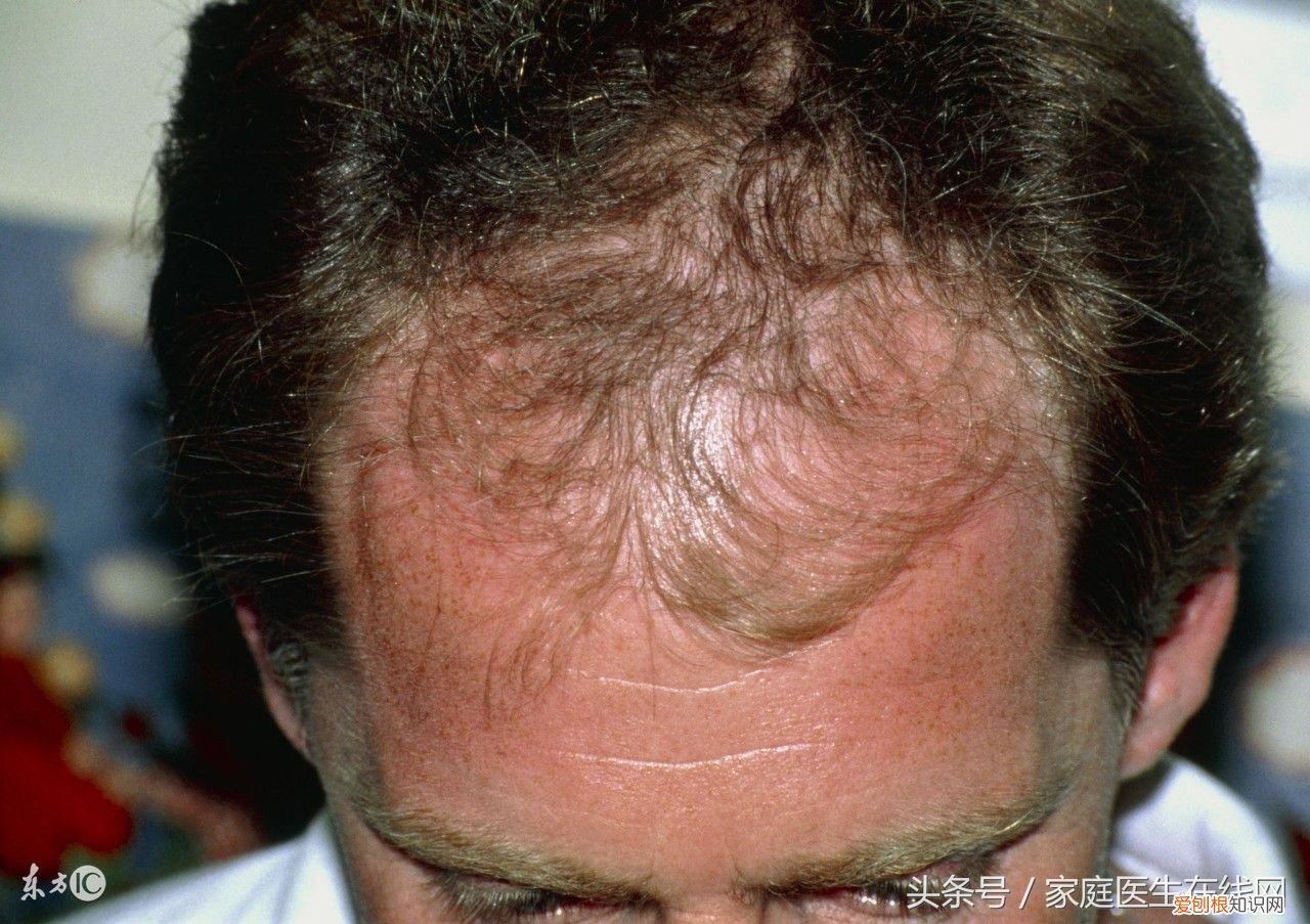 掉发严重是身体哪里出毛病了? 头发掉的厉害是