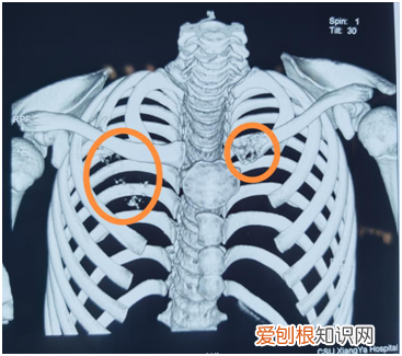 12岁男孩被查出肺癌晚 12岁男孩确诊肺癌晚期