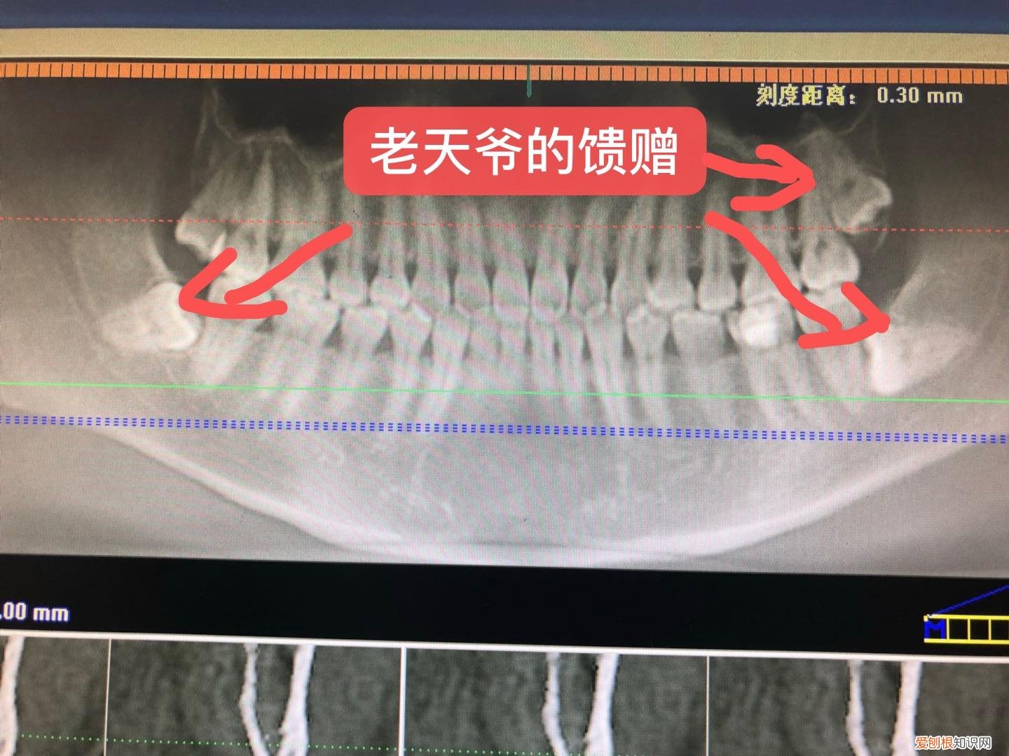长智齿应是大吉之意 有人说长智齿是吉兆