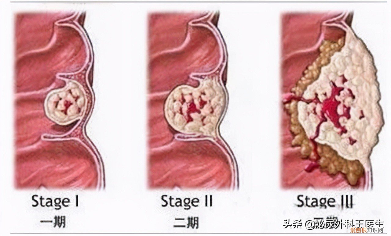 专家告诉你答案 痔疮最佳的自愈方法