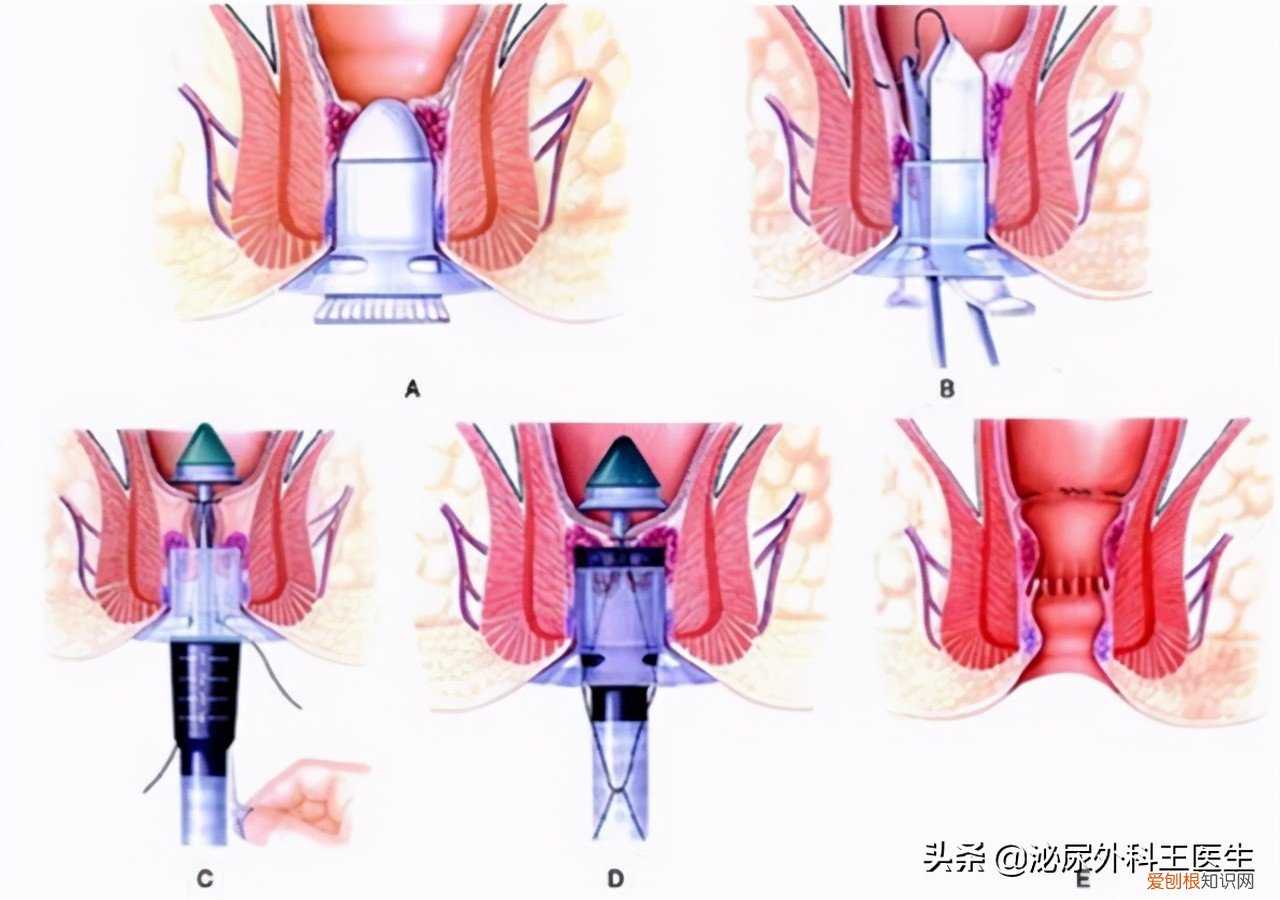 专家告诉你答案 痔疮最佳的自愈方法