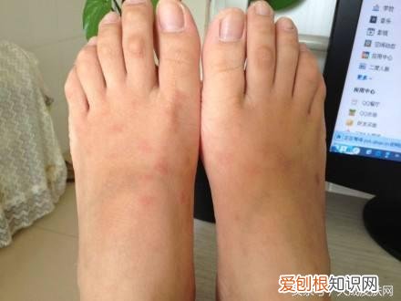 治疗荨麻疹的民间偏方有哪些？荨麻疹最怕三个土方法