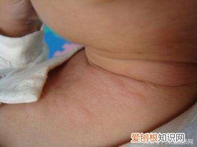治疗荨麻疹的民间偏方有哪些？荨麻疹最怕三个土方法