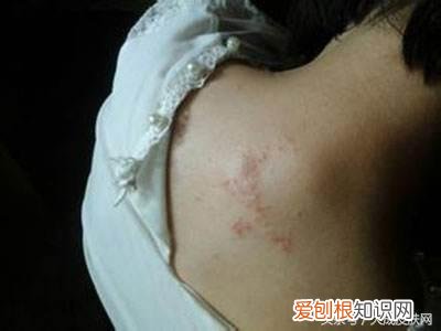 治疗荨麻疹的民间偏方有哪些？荨麻疹最怕三个土方法