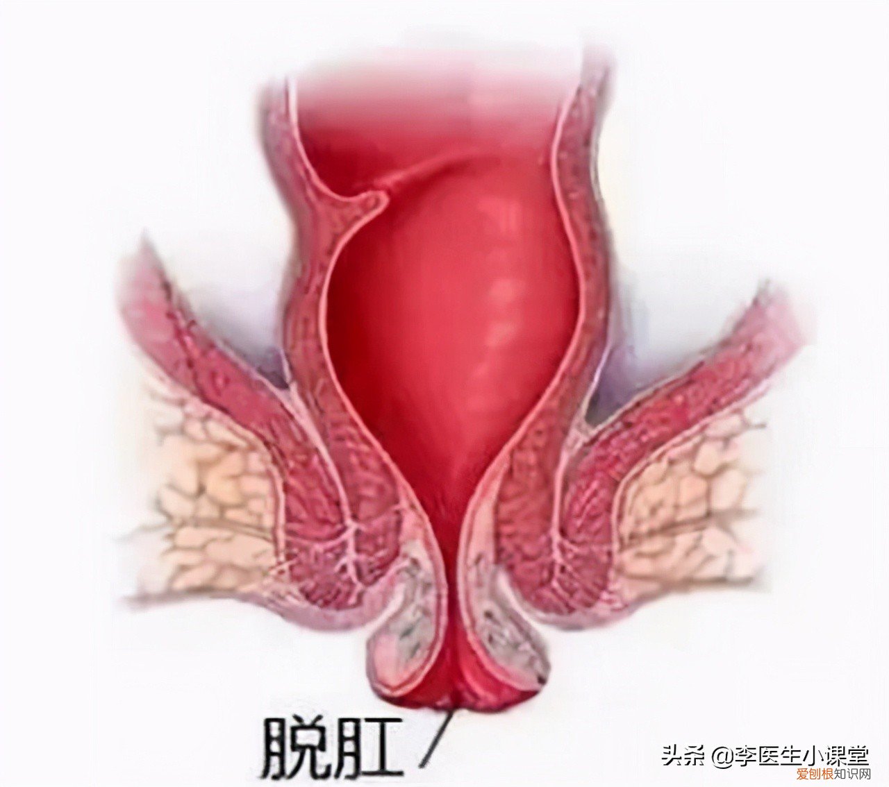 痔疮外痔肉球怎么消除？专家：2个方法这么用，痔疮肉球没有了