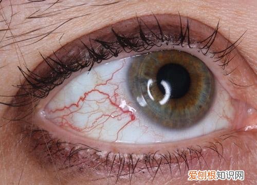 眼睛红红的像出血一样是怎么回事？除了疲劳还有这些原因