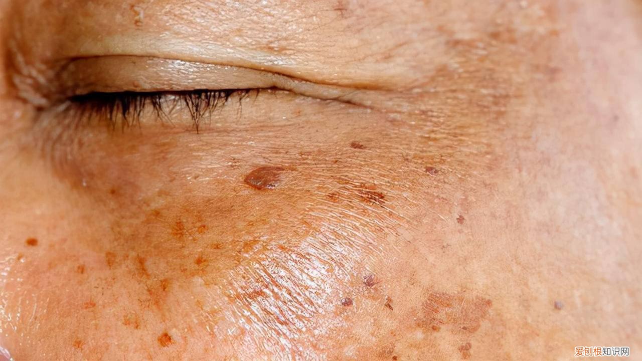 ve怎么用祛斑效果好 如何祛斑效果好