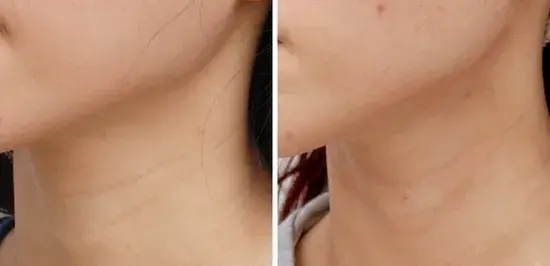 如何去除颈纹最有效 如何有效去除颈纹