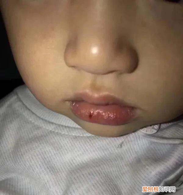 为什么嘴唇会脱皮 嘴唇脱皮的原因