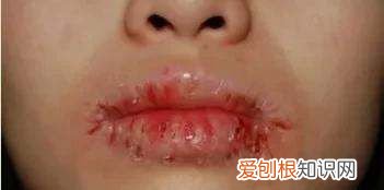 为什么嘴唇会脱皮 嘴唇脱皮的原因