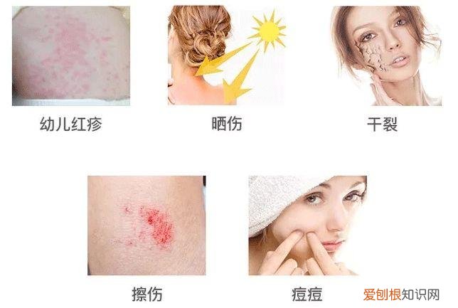 每天晚上坚持涂芦荟胶的效果 芦荟胶对痘痘和痘印有效果吗