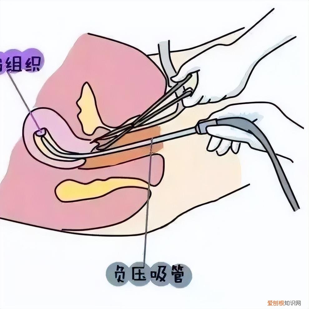 流产最佳时间是多少天到多少天