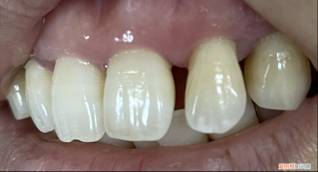 全瓷贴面牙齿价格
