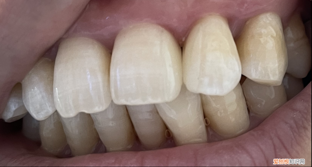 全瓷贴面牙齿价格