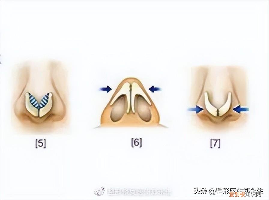 鼻头缩小手术的费用大概是多少啊