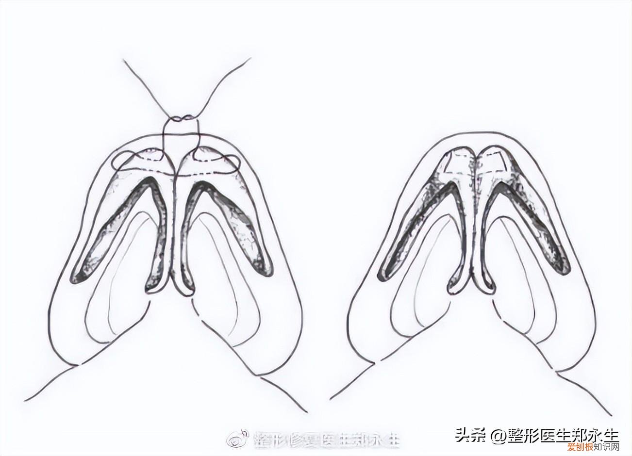 鼻头缩小手术的费用大概是多少啊