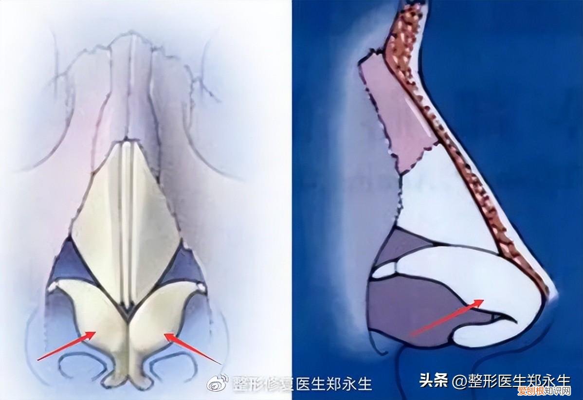 鼻头缩小手术的费用大概是多少啊