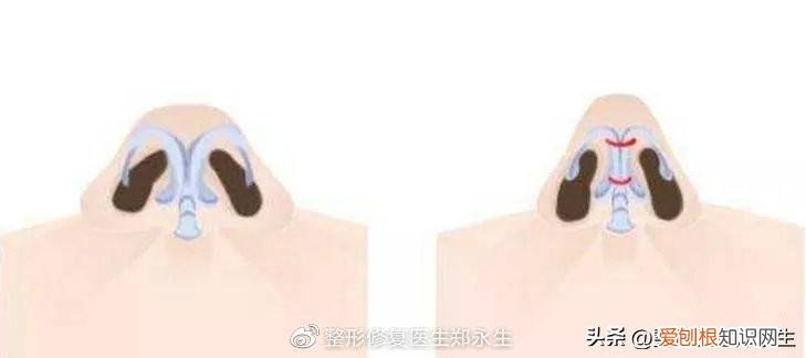 鼻头缩小手术的费用大概是多少啊