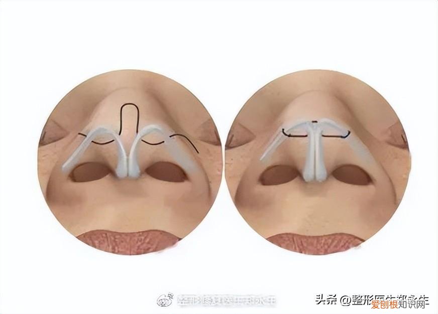 鼻头缩小手术的费用大概是多少啊