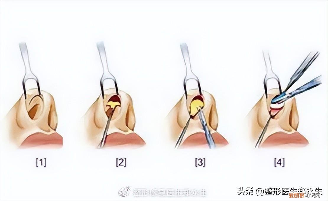 鼻头缩小手术的费用大概是多少啊