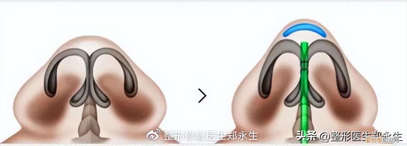 鼻头缩小手术的费用大概是多少啊
