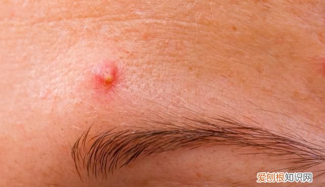 为什么眉毛会长痘