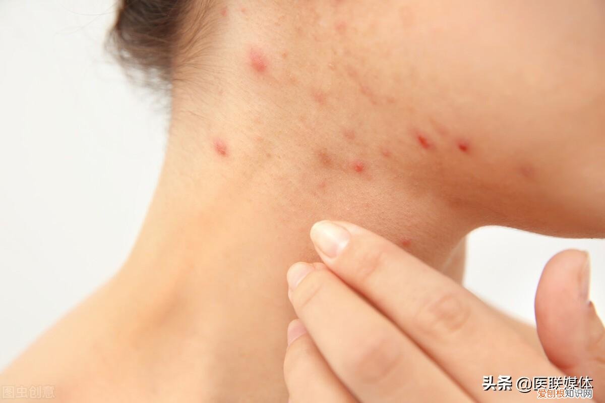 背部长痘痘是什么原因