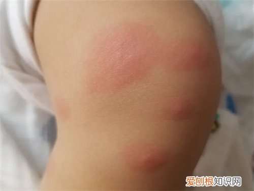 宝宝被蚊子咬了红肿特别大怎么办，宝宝被蚊子咬了红肿特别大怎么办肿