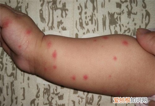 宝宝被蚊子咬了红肿特别大怎么办，宝宝被蚊子咬了红肿特别大怎么办肿
