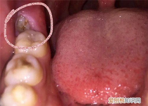 快速止牙痛的6个简单方法是什么