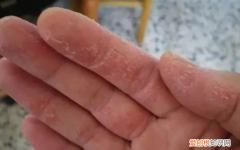 手足干裂是什么原因造成的 看看你是不是这样的