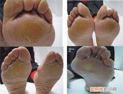 脚垫怎么治疗有效 6种方法教你完美治疗各种脚垫