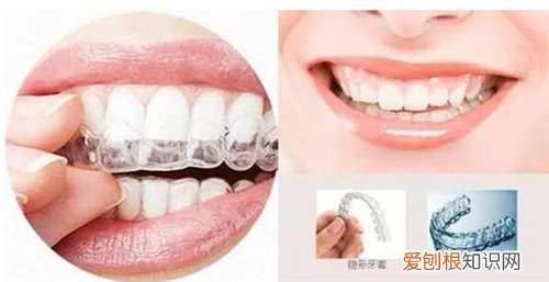 自锁托槽有哪些优点 托槽掉了要怎么处理