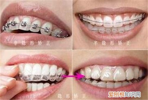 自锁托槽有哪些优点 托槽掉了要怎么处理